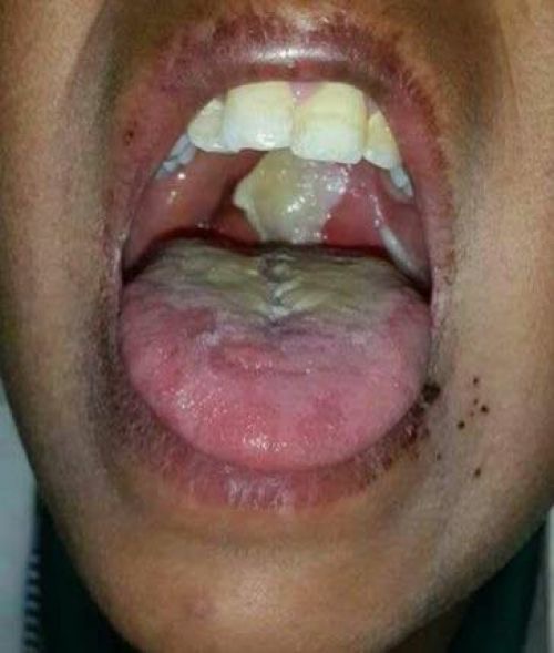 وزارة الصحة: تسجيل 202 إصابة بالدفتيريا خلال 2025 ووفاة 15 حالة